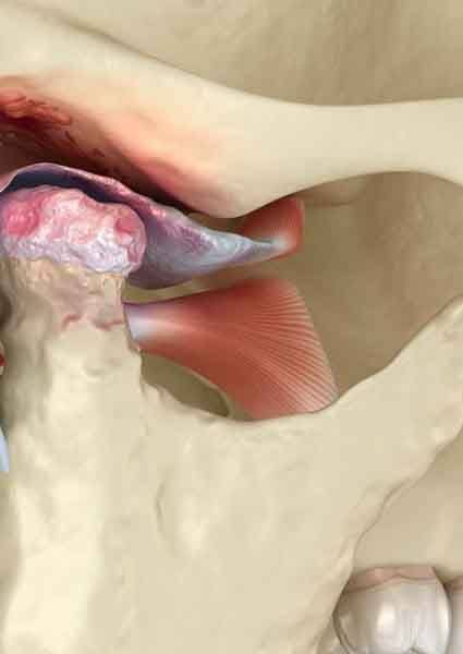 Close-up illustration of damaged temporomandibular joint